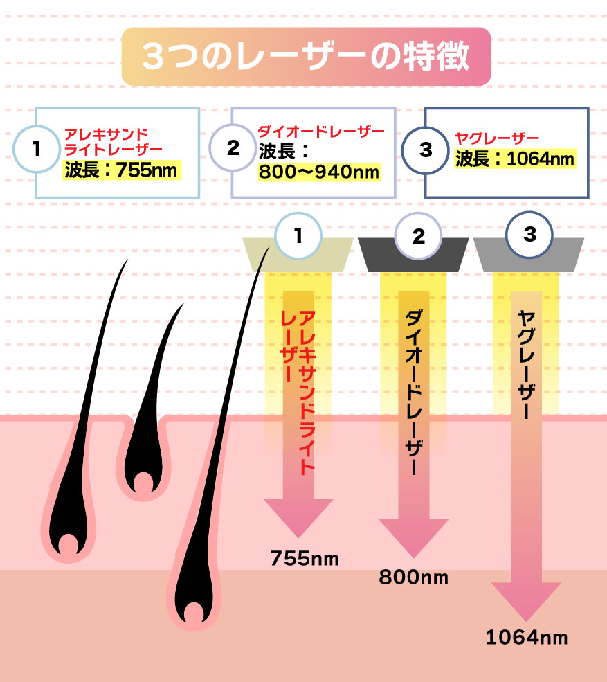 医療レーザーの特徴