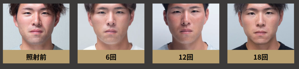 ゴリラクリニックヒゲ脱毛18回の効果
