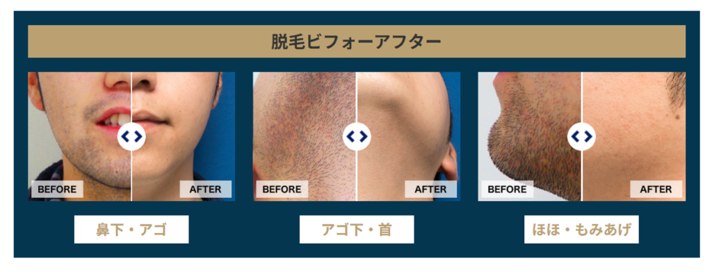 ゴリラクリニックヒゲ脱毛12回の効果