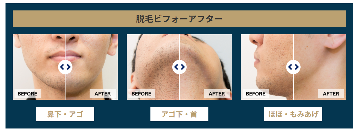 ゴリラクリニックのヒゲ脱毛6回の効果