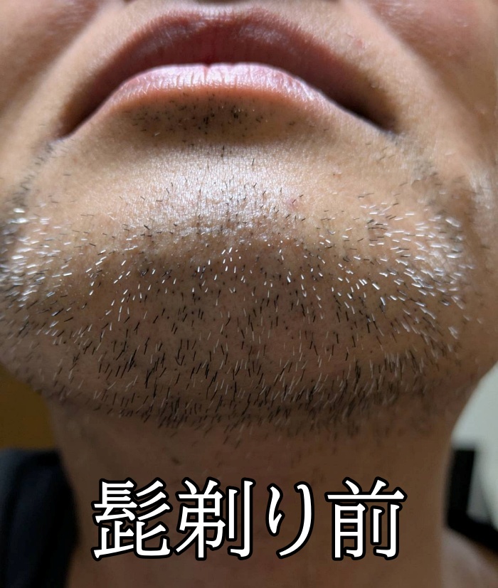 メンズエミナルでヒゲ脱毛施術前の状態「髭剃り前」