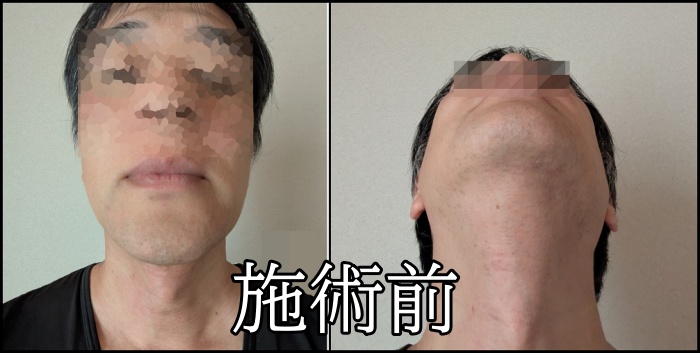 メンズエミナルのヒゲ脱毛施術前に剃った様子