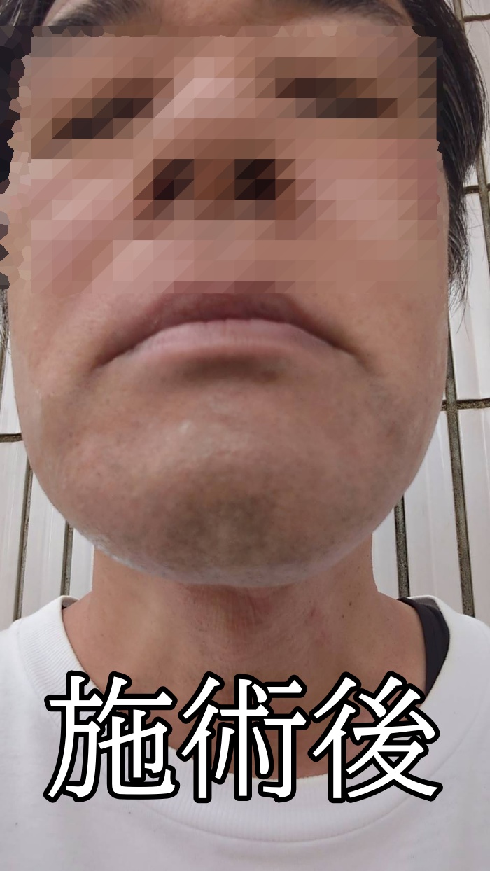 メンズエミナルのヒゲ脱毛施術後