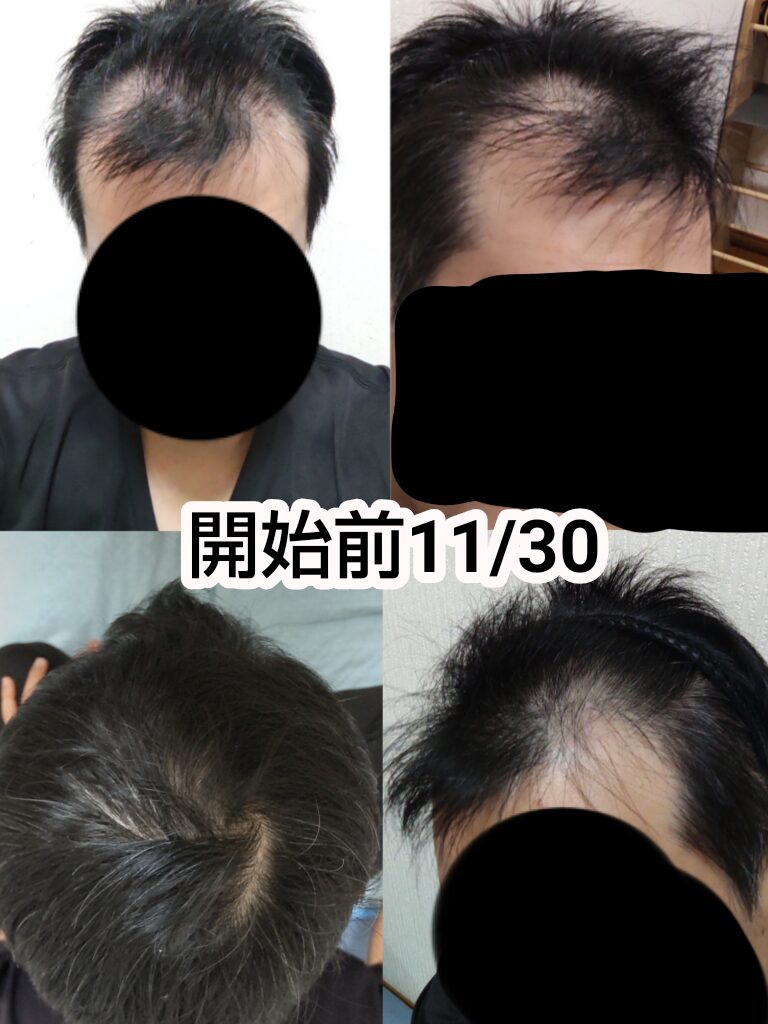 M字ミノキシジル＋フィナステリドでAGA治療（開始前）