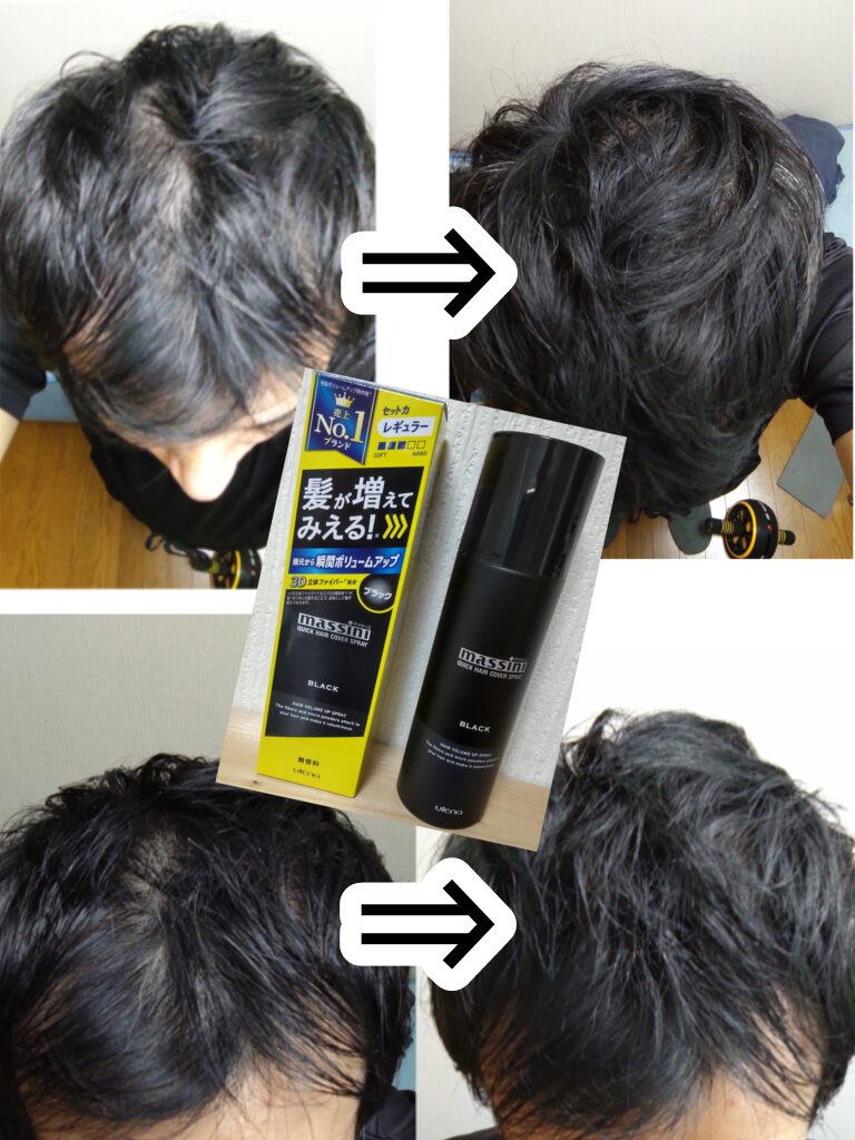 40代M字ミノキシジル＋フィナステリドでAGA治療（髪が増えてみえるスプレーでこう変わる）