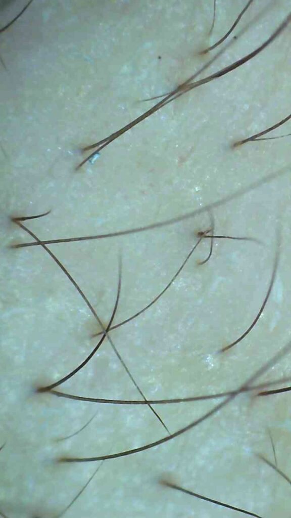 ミノキシジルで産毛が生えてきたM字