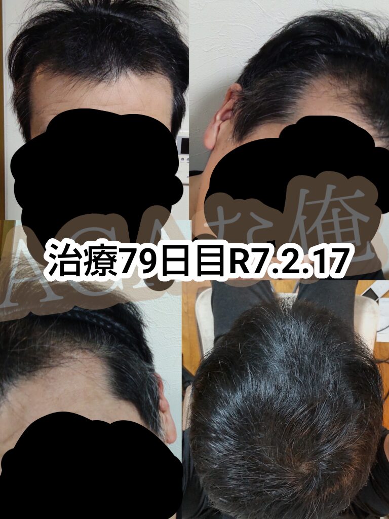 40代M字ハゲがミノキシジル＋フィナステリドでAGA治療（79日目）