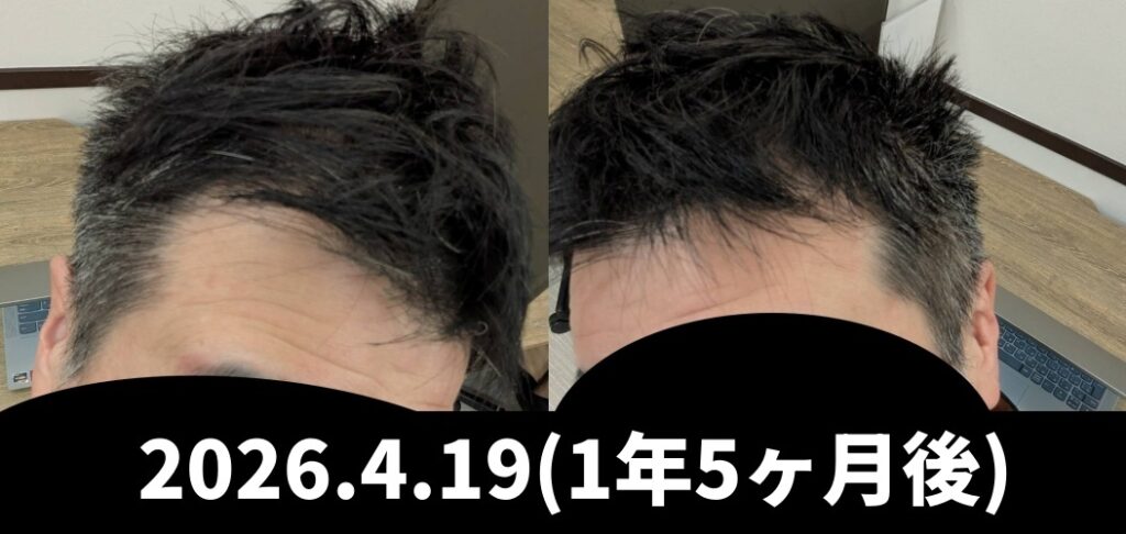 フィナステリドのみの経過（現状維持）M字