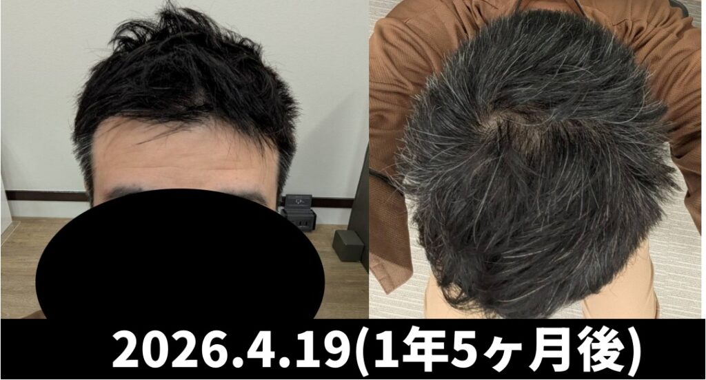 フィナステリドのみの経過（正面・後頭部）