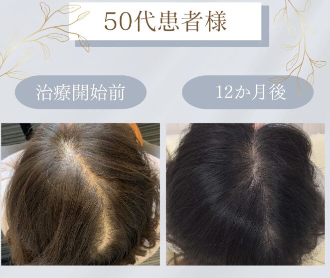 リアスクリニック名古屋院女性の薄毛治療50代症例