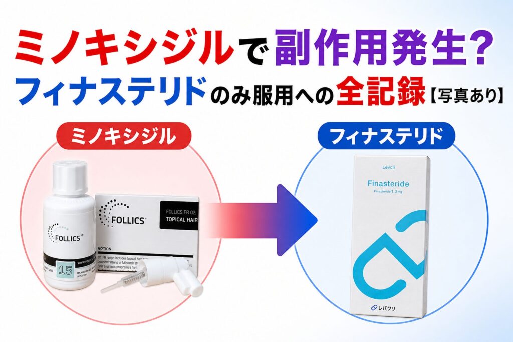 ミノキシジルからフィナステリド単剤へ