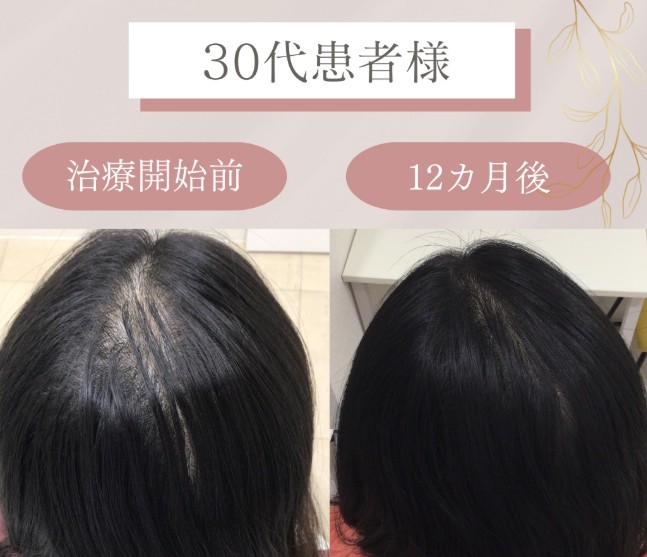 リアスクリニック名古屋院女性の薄毛治療症例（30代女性）