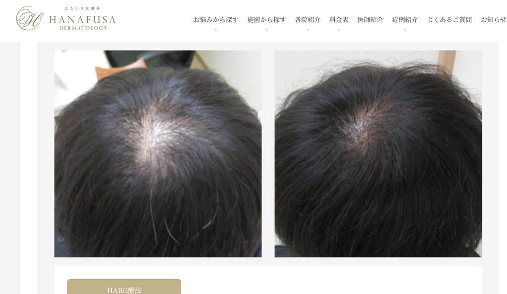 はなふさ皮膚科女性の薄毛治療症例